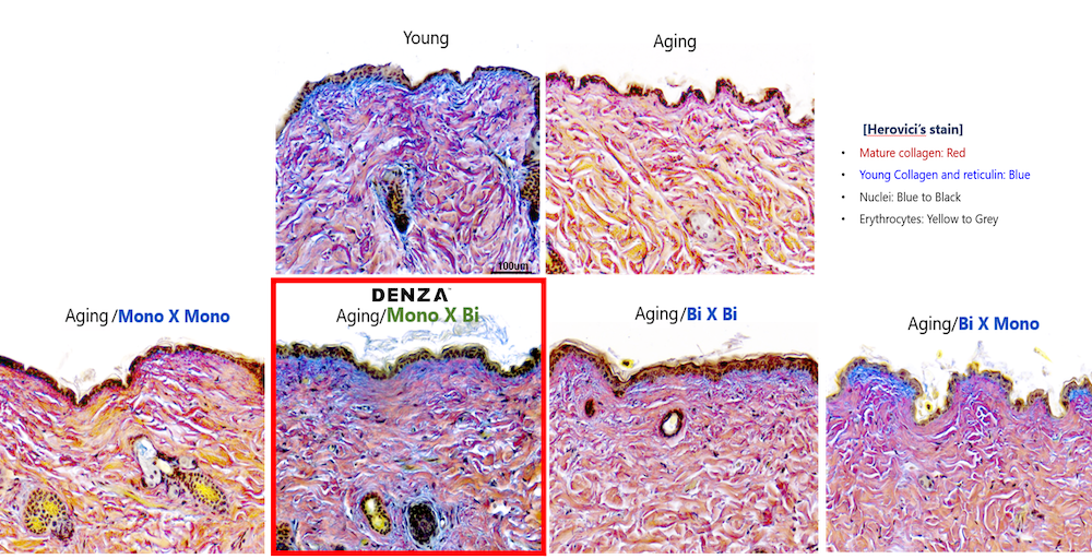 Denza histology