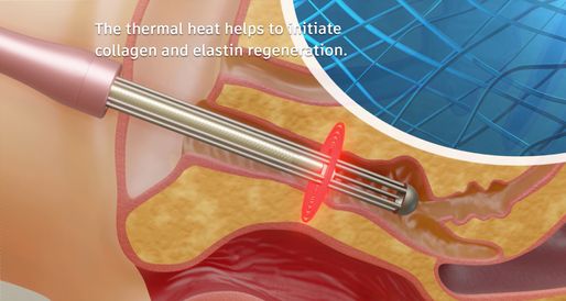 Illustration of Lyra™ treatments