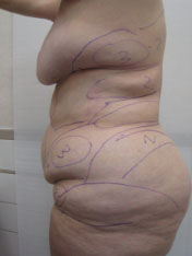 Before MicroTight™ results - side view