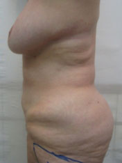 After MicroTight™ results - side view