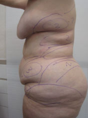 Before MicroTight™ results - side view