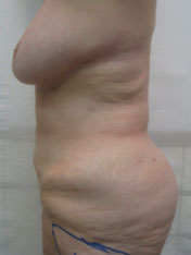After MicroTight™ results - side view