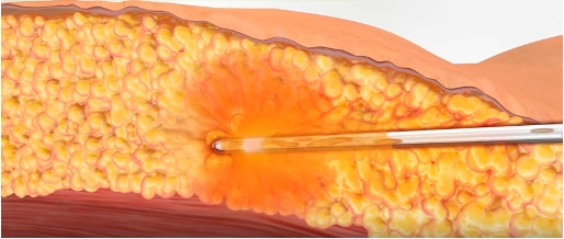 Image of subcutaneous fat
