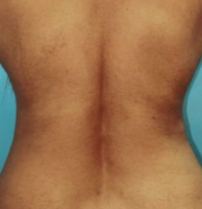microtight-before-1